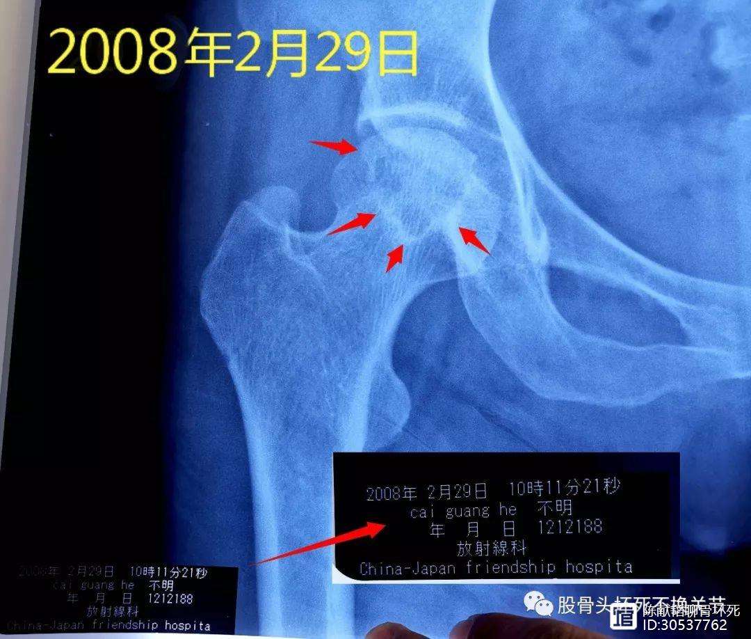 铜陵人工骨头医保报销多少(人工骨头医保报销多少比例)